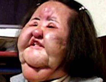 Korean Hang Mioku injected cooking oil on her face, is she still alive? Wiki